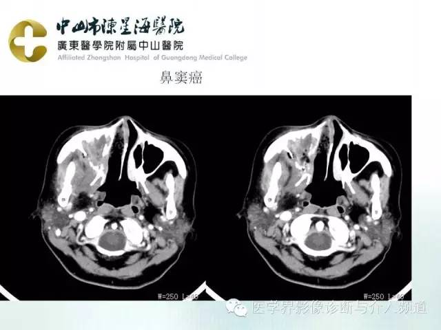 结外NK/T细胞淋巴瘤