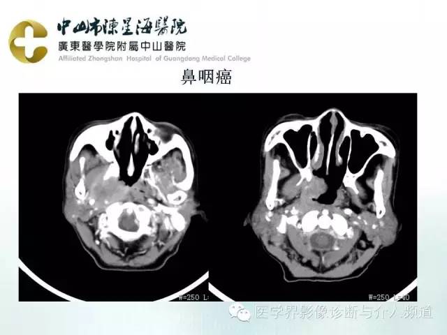 结外NK/T细胞淋巴瘤