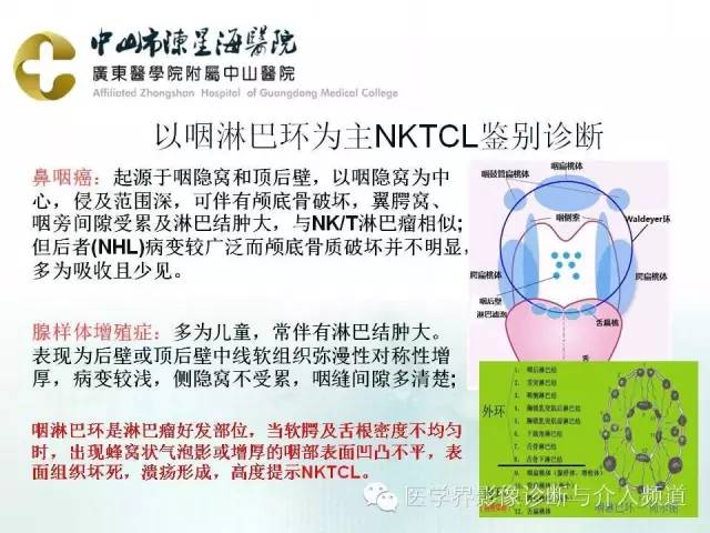 结外NK/T细胞淋巴瘤