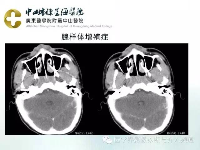 结外NK/T细胞淋巴瘤