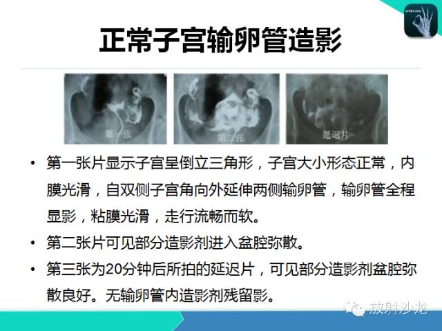 【PPT】子宫输卵管造影