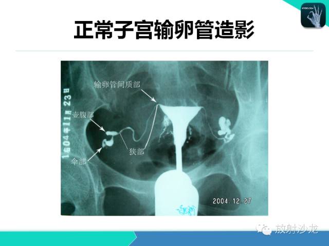 【PPT】子宫输卵管造影