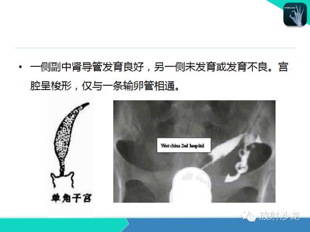 【PPT】子宫输卵管造影