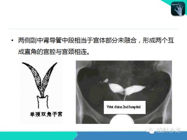 【PPT】子宫输卵管造影