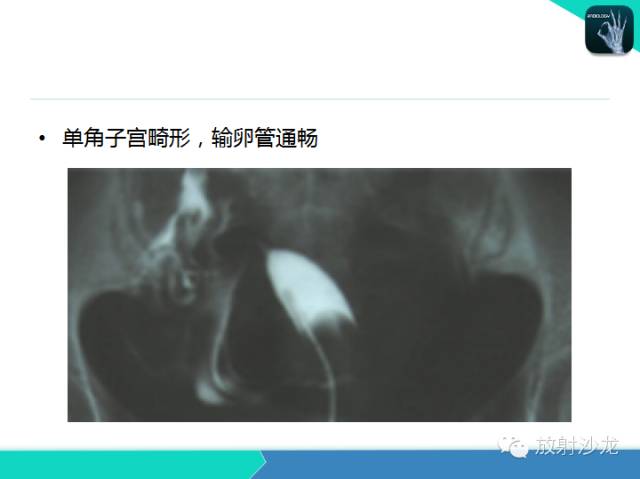 【PPT】子宫输卵管造影