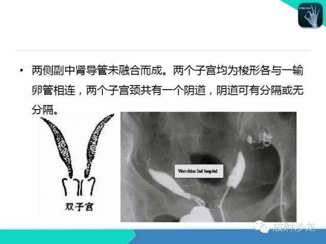 【PPT】子宫输卵管造影