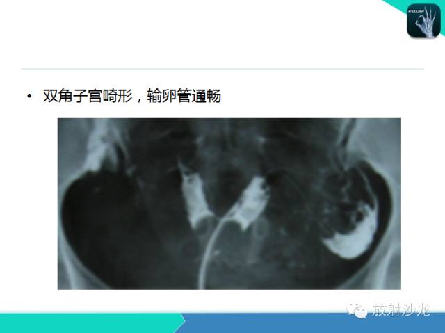 【PPT】子宫输卵管造影