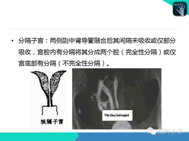 【PPT】子宫输卵管造影
