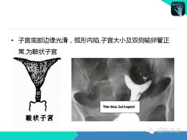 【PPT】子宫输卵管造影