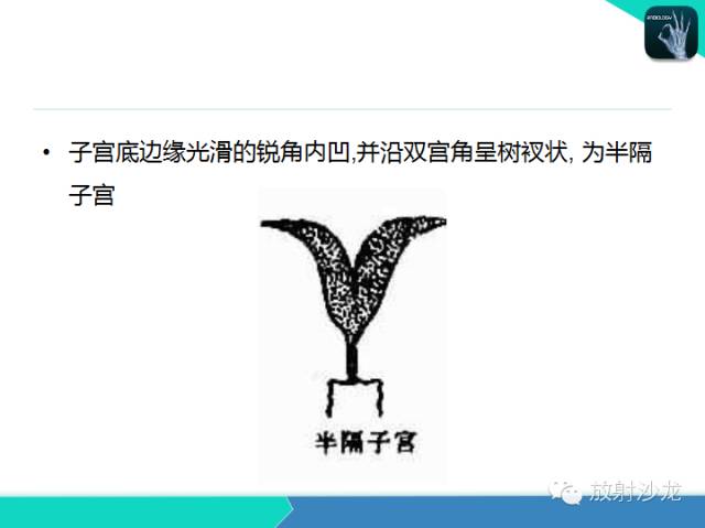 【PPT】子宫输卵管造影
