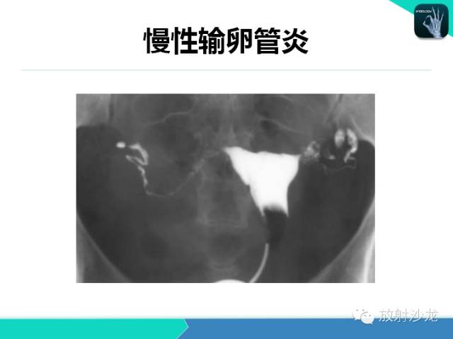 【PPT】子宫输卵管造影