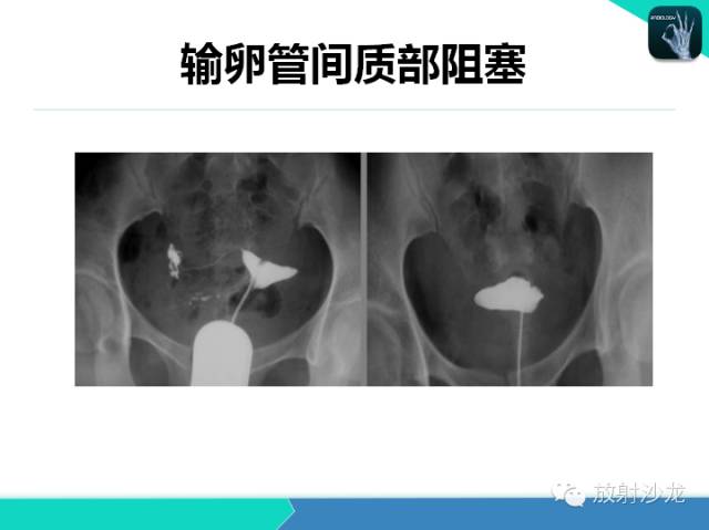 【PPT】子宫输卵管造影