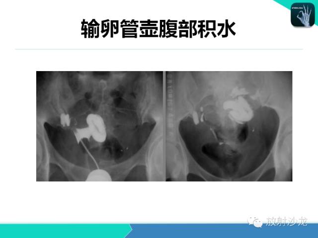 【PPT】子宫输卵管造影