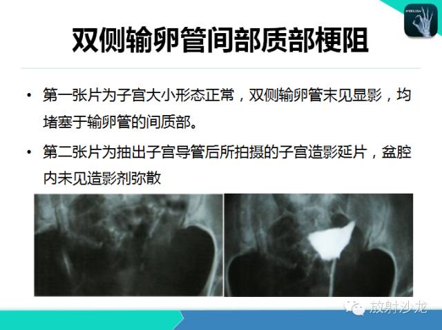 【PPT】子宫输卵管造影
