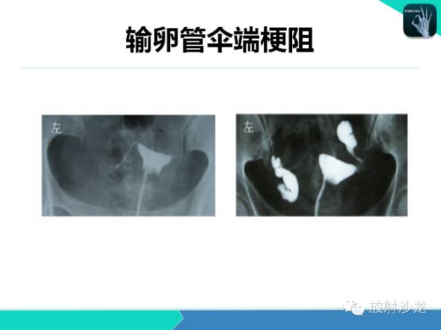 【PPT】子宫输卵管造影