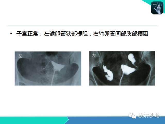 【PPT】子宫输卵管造影
