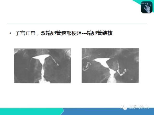 【PPT】子宫输卵管造影