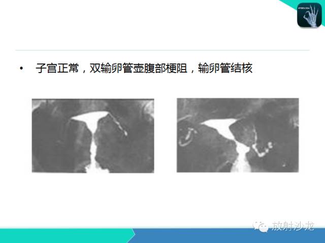 【PPT】子宫输卵管造影