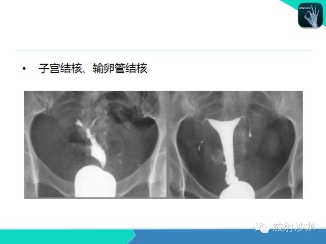 【PPT】子宫输卵管造影