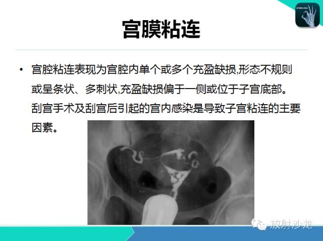 【PPT】子宫输卵管造影