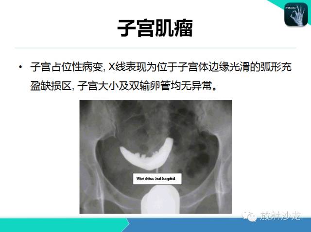 【PPT】子宫输卵管造影