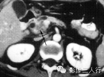 胰腺实性疾病的鉴别诊断