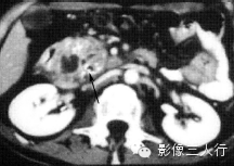 胰腺实性疾病的鉴别诊断 胰腺实性疾病的鉴别诊断