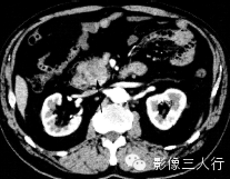 胰腺实性疾病的鉴别诊断 胰腺实性疾病的鉴别诊断