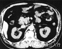 胰腺实性疾病的鉴别诊断 胰腺实性疾病的鉴别诊断