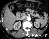 胰腺实性疾病的鉴别诊断 胰腺实性疾病的鉴别诊断