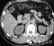 胰腺实性疾病的鉴别诊断 胰腺实性疾病的鉴别诊断