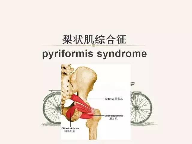 【PPT】梨状肌综合征