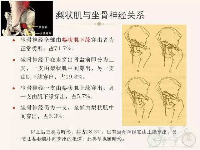 【PPT】梨状肌综合征