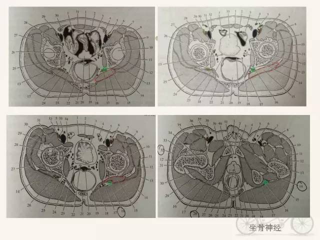 【PPT】梨状肌综合征