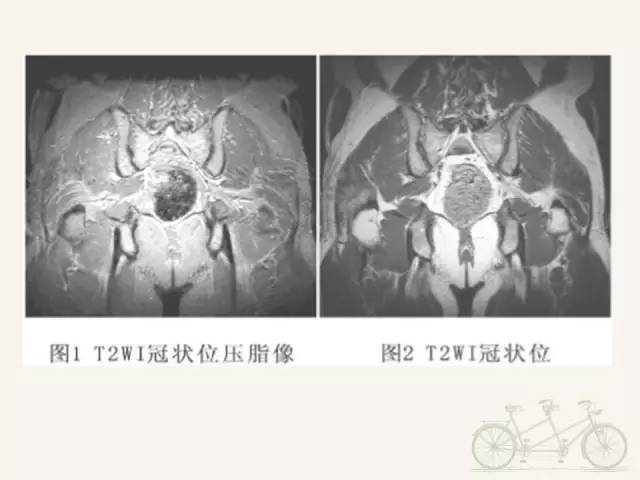 【PPT】梨状肌综合征