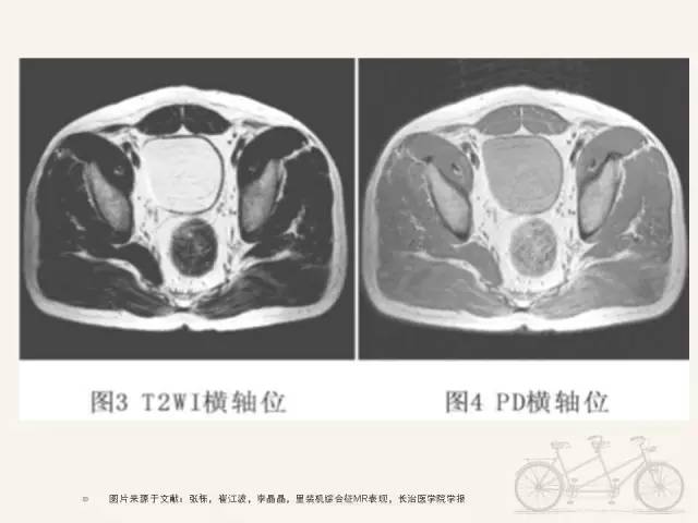 【PPT】梨状肌综合征