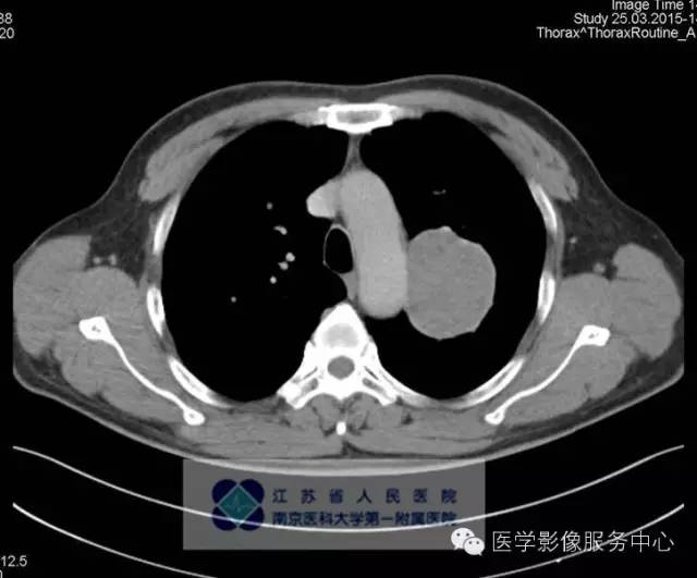 【病例】肺类癌1例CT影像表现 【病例】肺类癌1例CT影像表现