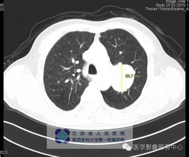 【病例】肺类癌1例CT影像表现