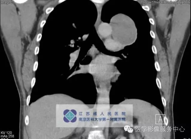 【病例】肺类癌1例CT影像表现 【病例】肺类癌1例CT影像表现