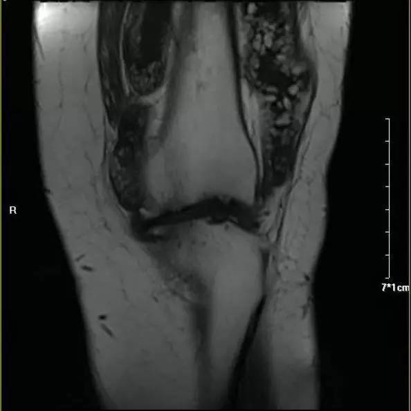 【病例】膝关节滑膜树枝状脂肪瘤1例MR影像 【病例】膝关节滑膜树枝状脂肪瘤1例MR影像