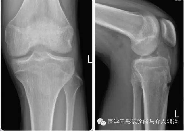 【病例】软骨母细胞瘤1例影像表现