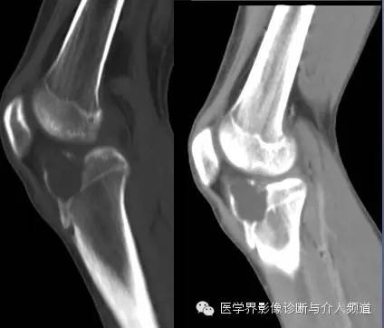 【病例】软骨母细胞瘤1例影像表现 【病例】软骨母细胞瘤1例影像表现