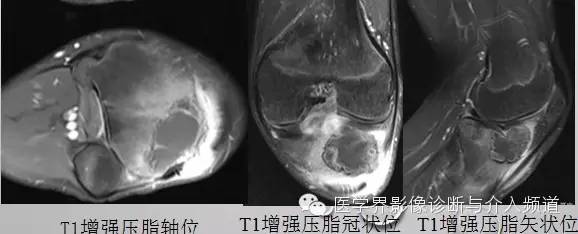 【病例】软骨母细胞瘤1例影像表现 【病例】软骨母细胞瘤1例影像表现