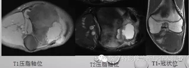 【病例】软骨母细胞瘤1例影像表现 【病例】软骨母细胞瘤1例影像表现
