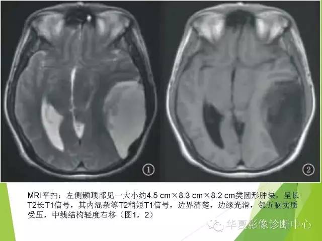 【病例】颅内孢子丝菌病1例MR影像表现