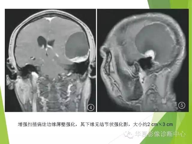 【病例】颅内孢子丝菌病1例MR影像表现