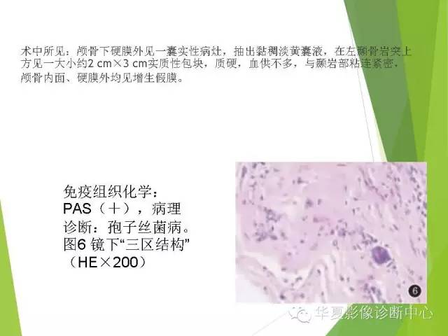 【病例】颅内孢子丝菌病1例MR影像表现