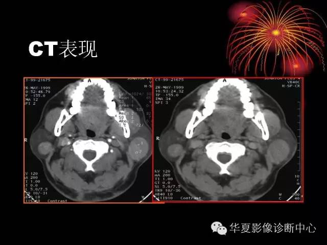 【病例】腮腺常见病变影像诊断