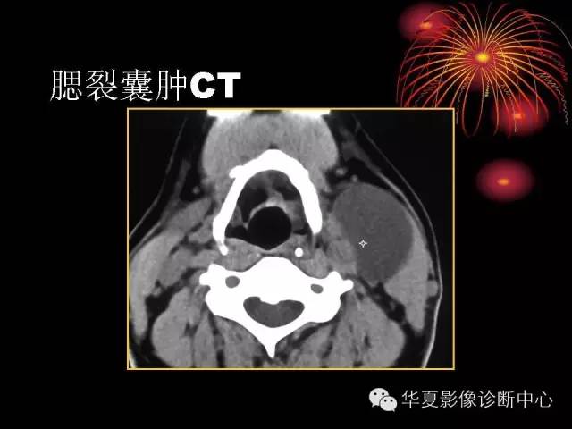 【病例】腮腺常见病变影像诊断