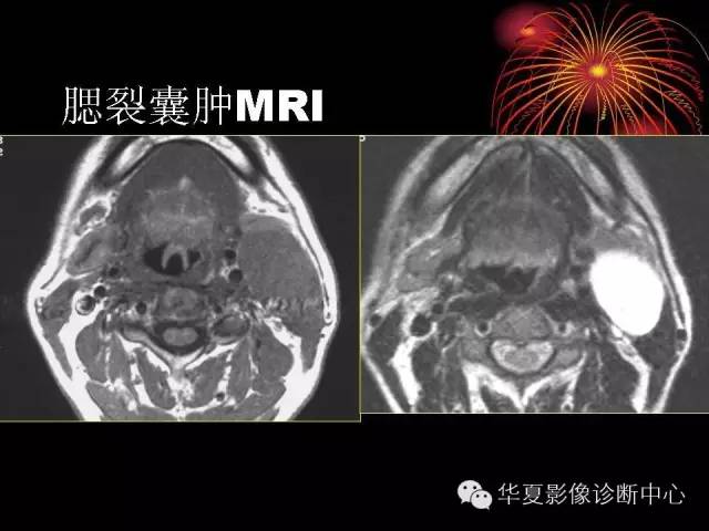 【病例】腮腺常见病变影像诊断